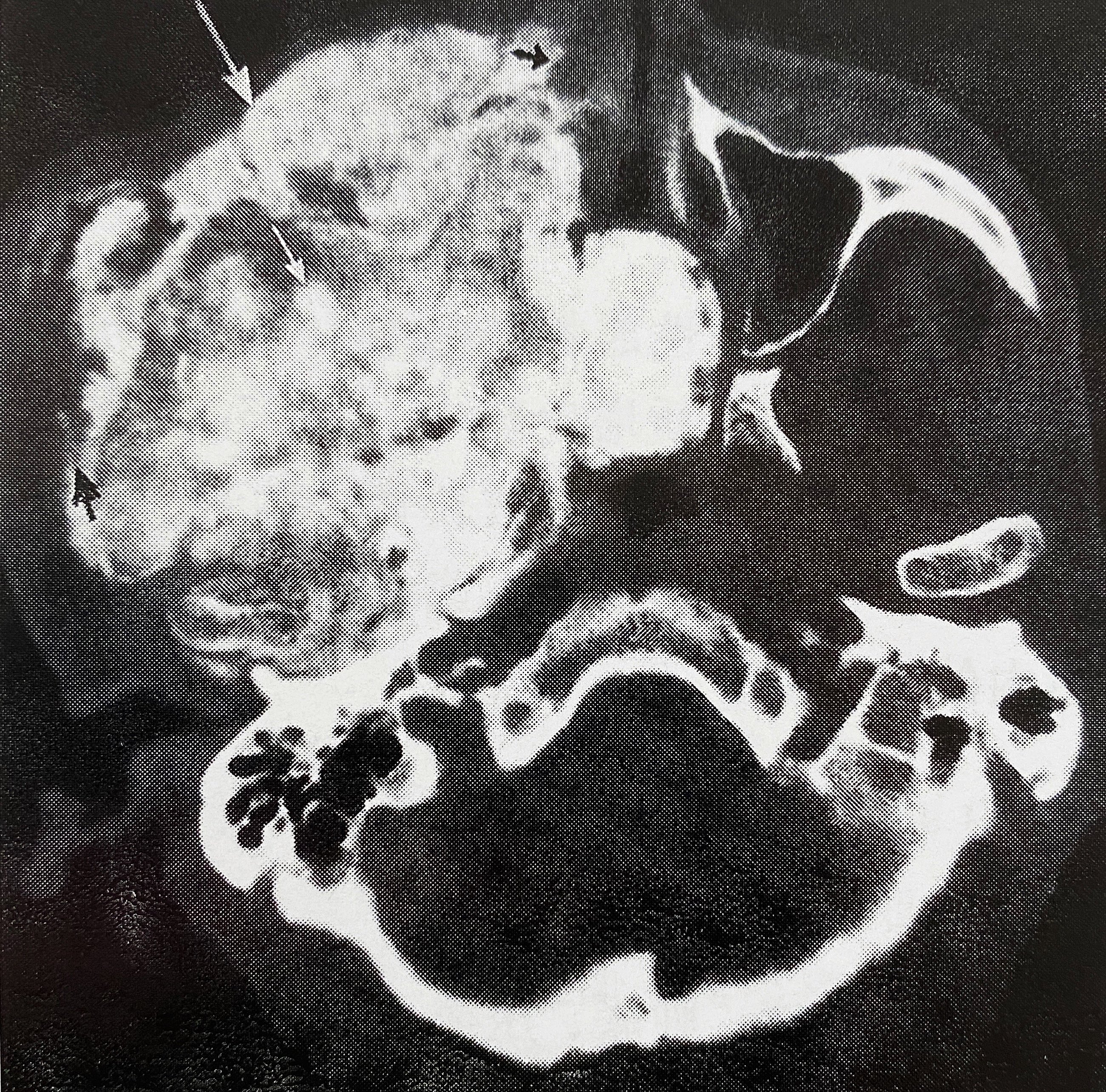 成骨细胞瘤_骨肿瘤_骨肿瘤介绍 - 好大夫在线