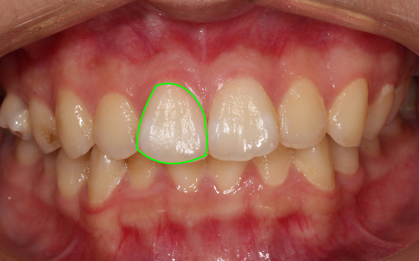 牙龈黑三角可以预防吗?怎么消除?