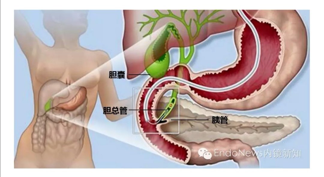 胆管症状疼痛位置图图片