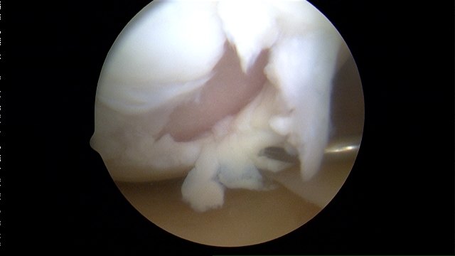 articular-cartilage-injury.jpg