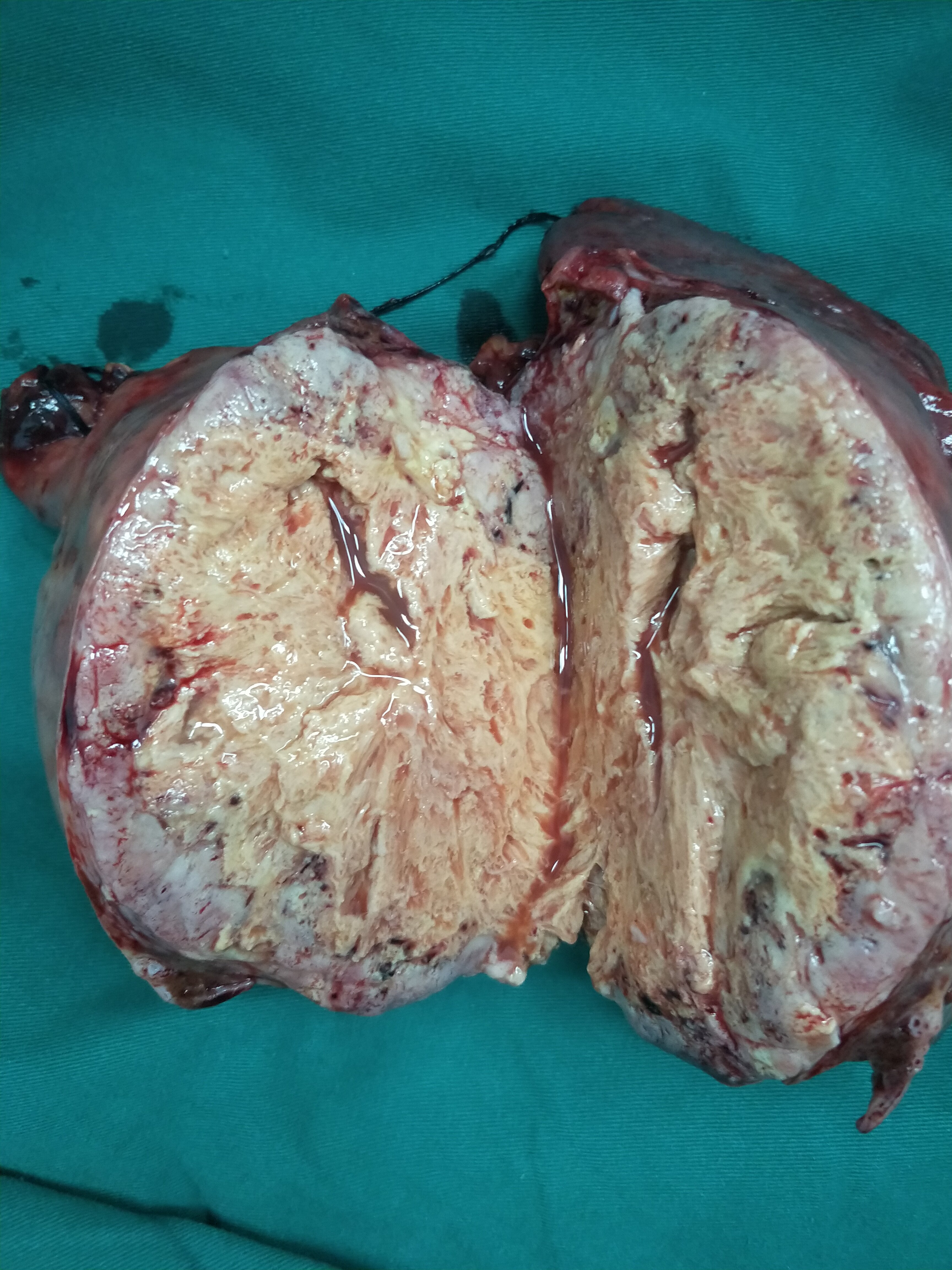 肝肿瘤图片 初期图片