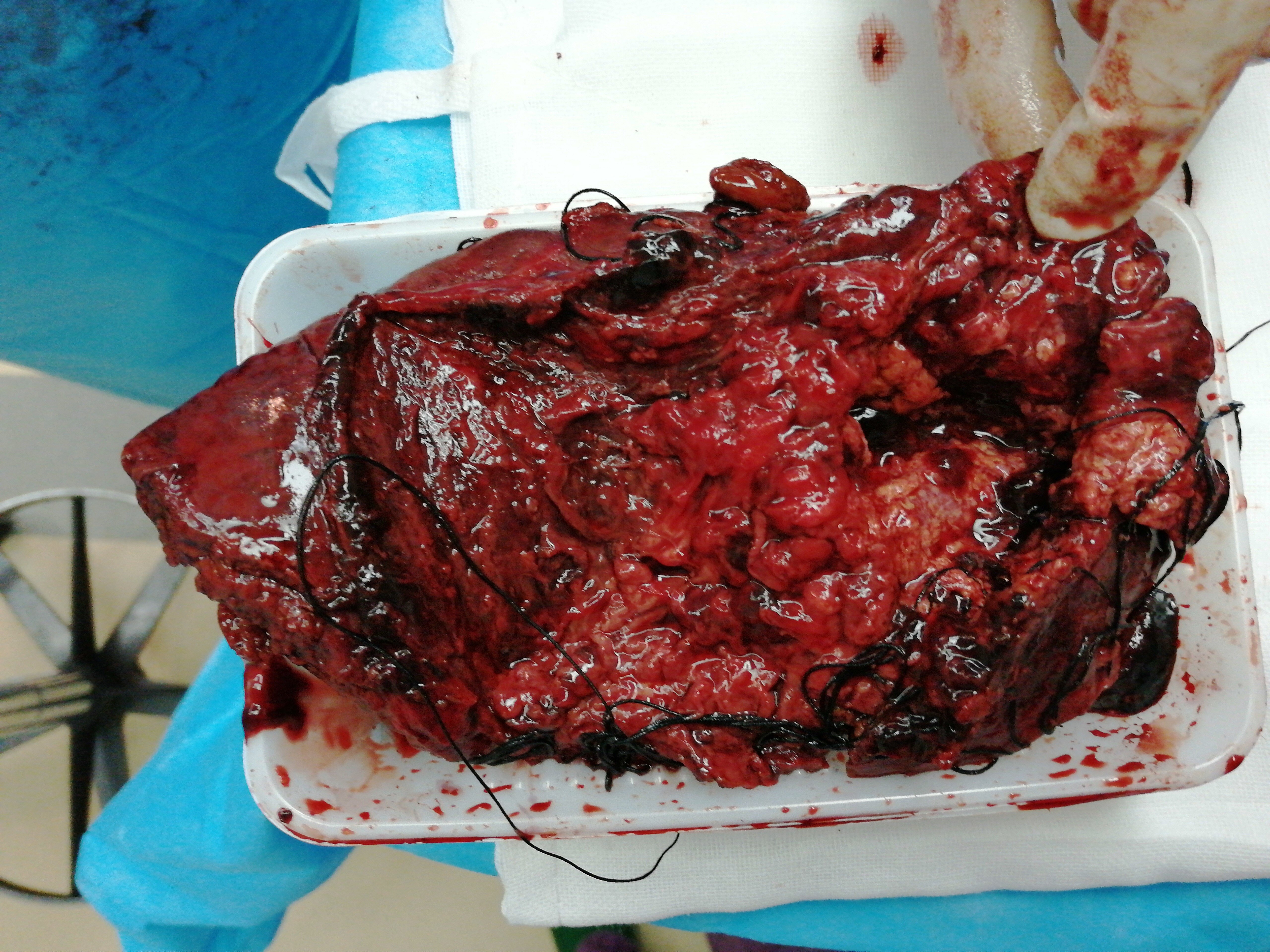 肝脓肿破裂大出血休克行肝叶及脓肿切除顺利恢复 - 好大夫在线