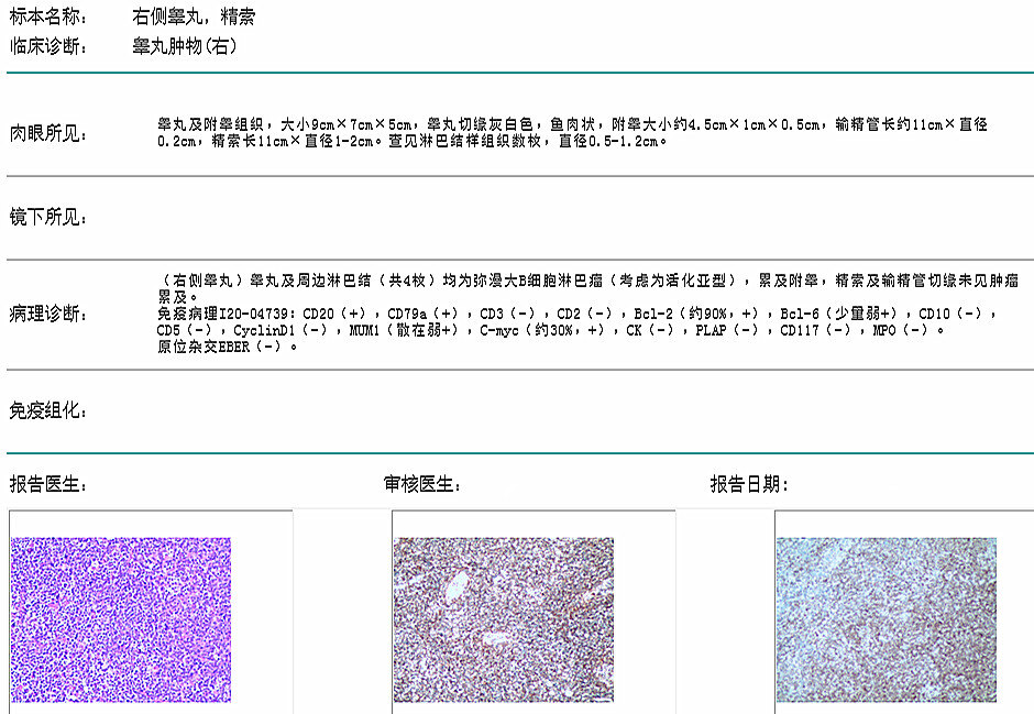 阴囊皮下脂肪瘤左侧附睾囊肿直径超过睾丸,临床上比较罕见,而且患者