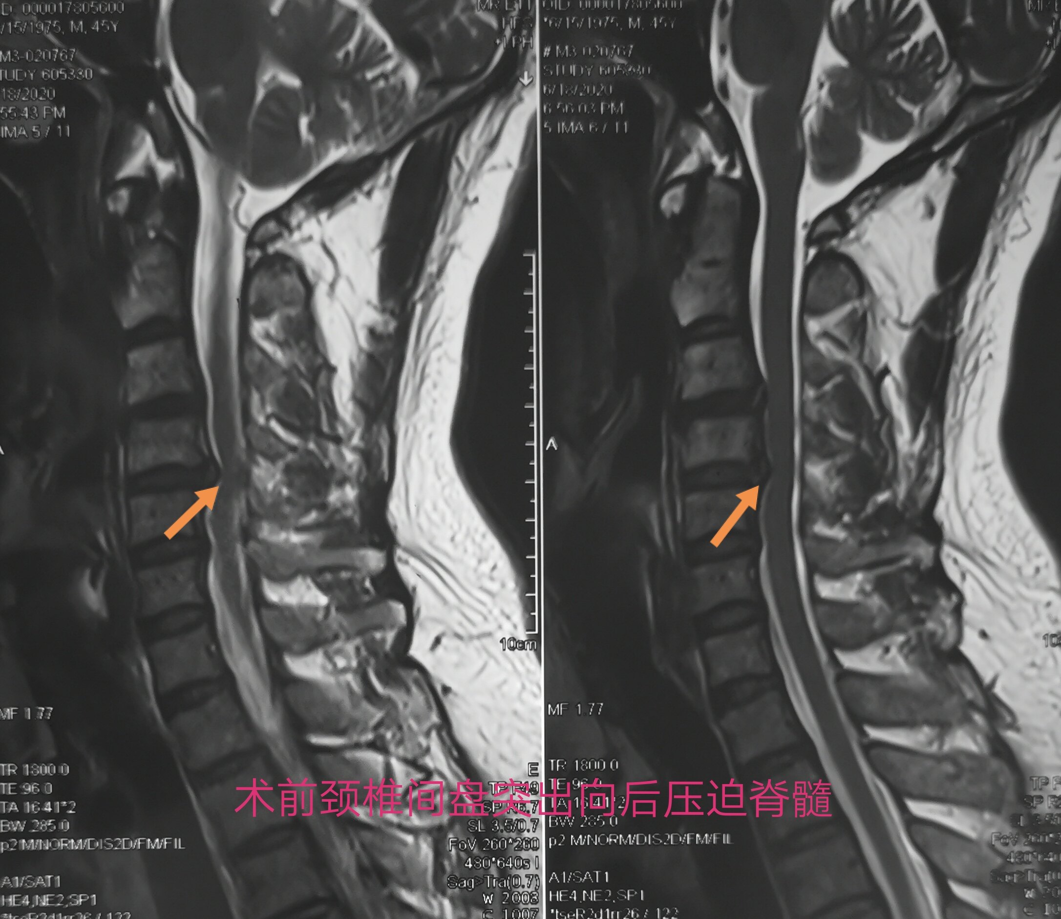第二颈椎棘突图片