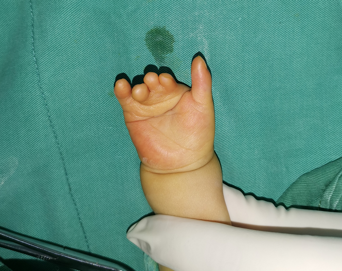 波兰综合征术后三个月的恢复情况_波兰氏综合症_治疗方式_康复锻炼