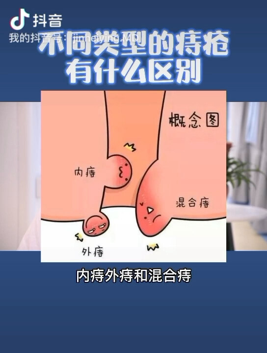 痔疮种类图片