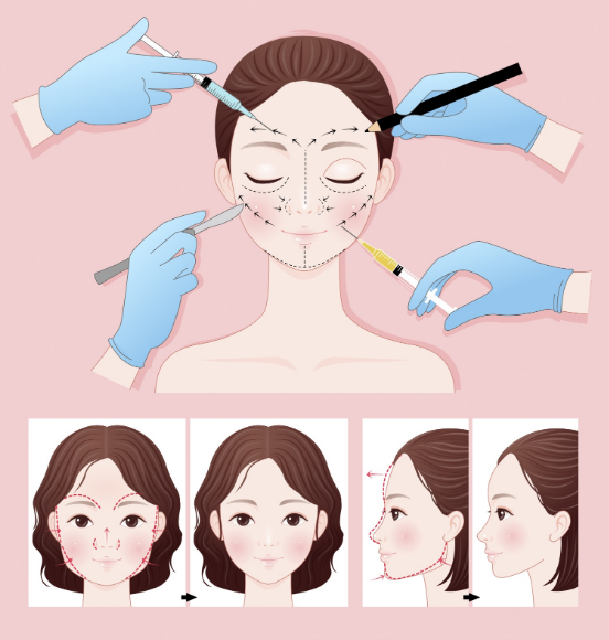 打肉毒素可能会有什么后遗症_肉毒素除皱 - 好大夫在线