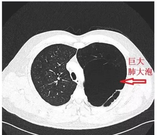 肺大泡是什么病严重吗图片