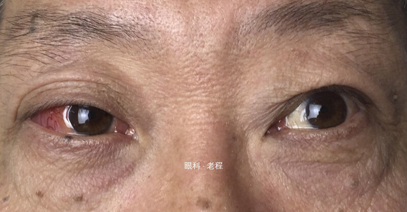 发病率如何?_眼眶肿瘤_眼眶肿瘤介绍 - 好大夫在线