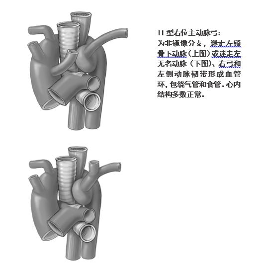 右位主动脉弓图片图片
