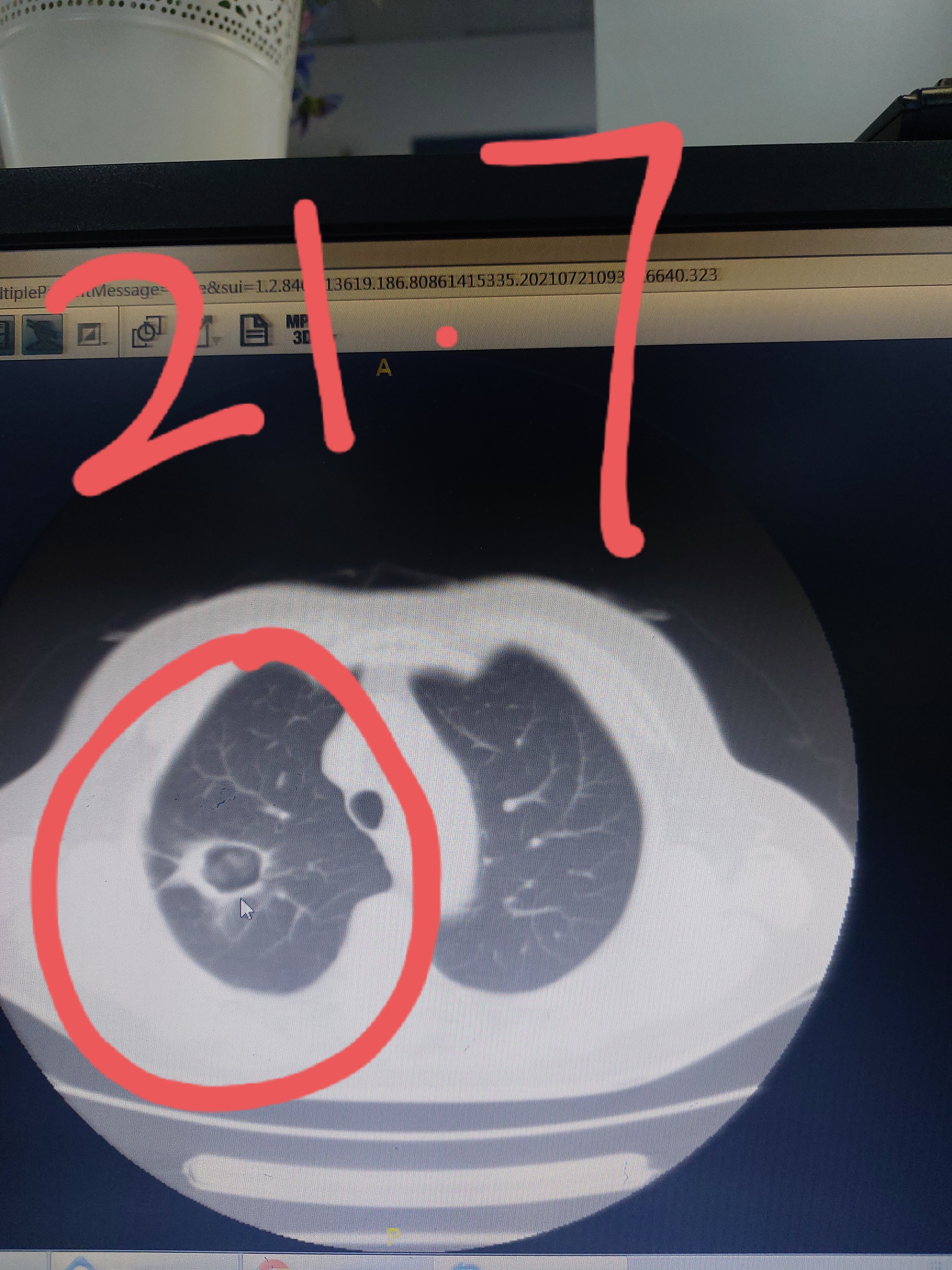 中分化肺鳞癌图片