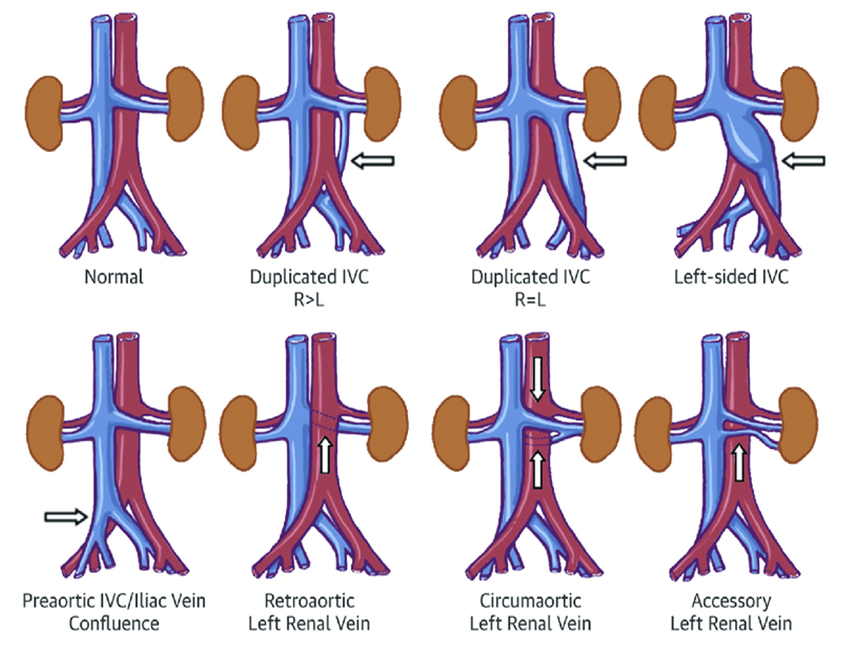话说下腔静脉血栓_深静脉血栓形成_深静脉血栓形成介绍 - 好大夫在线