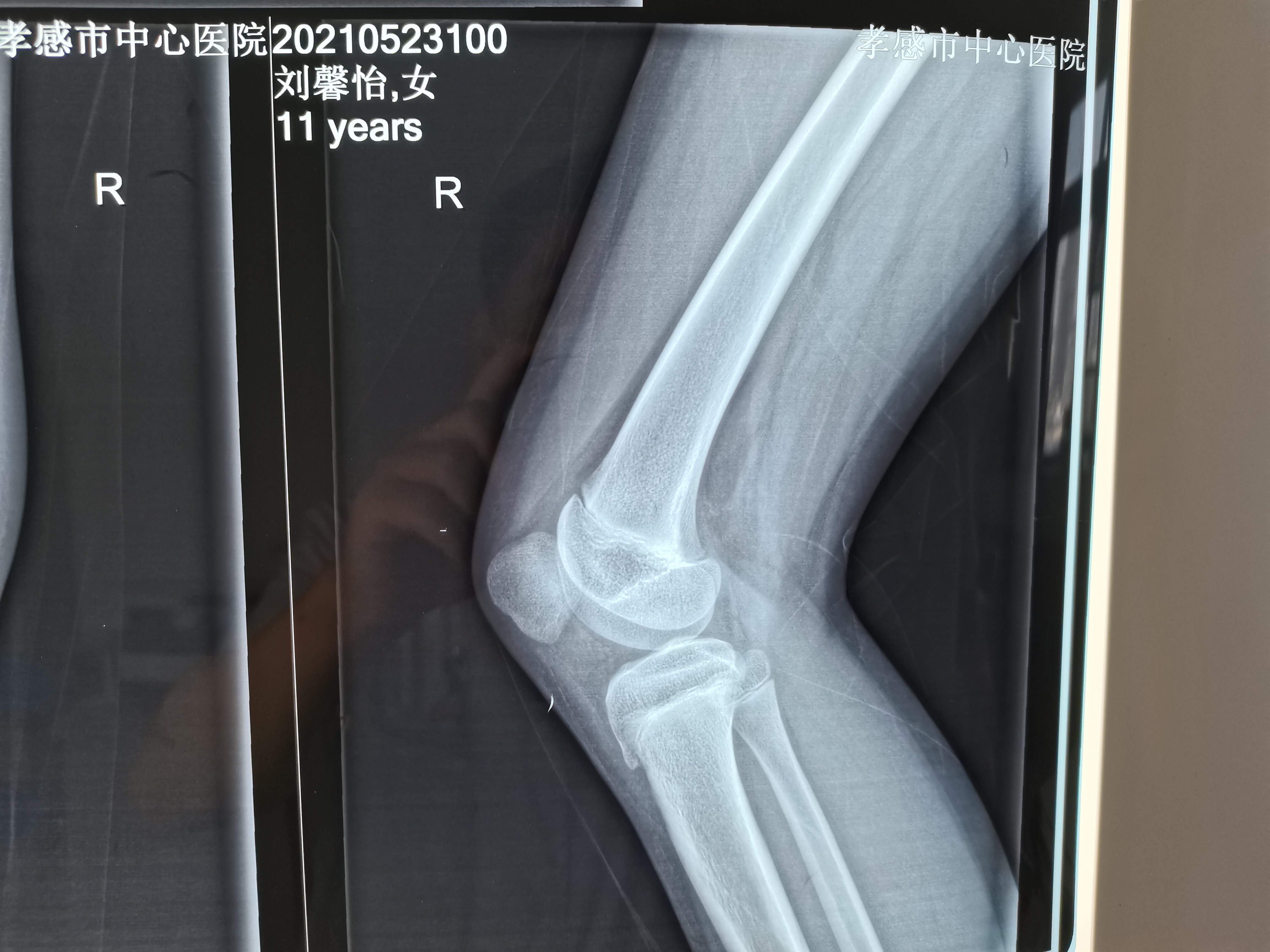 x光片膝盖图片