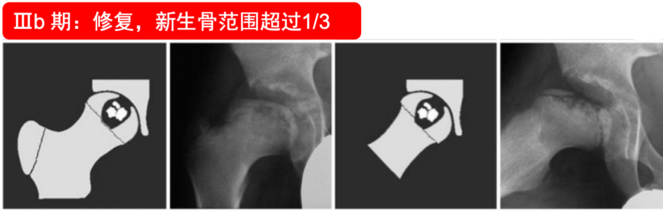 1/3愈合期(4期):修复完全,不可见坏死骨及不成熟编织骨对于perthes病