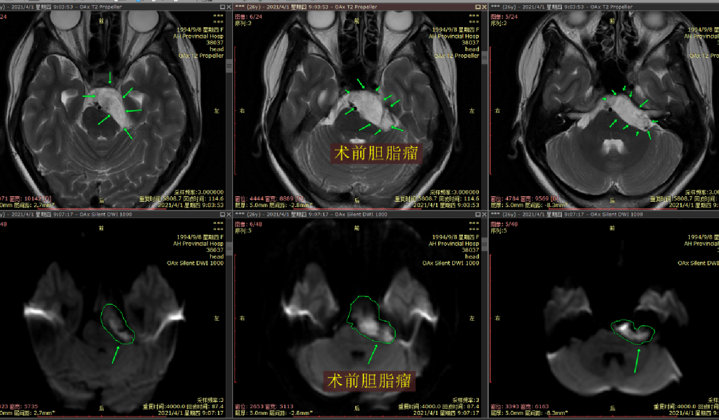 桥小脑角区胆脂瘤图片