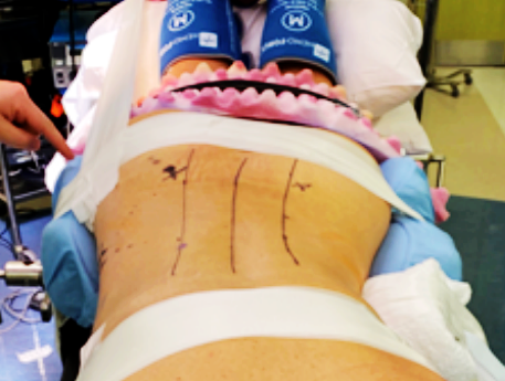 "俯卧位"llif手术:cadaver 可行性研究及早期临床经验 - 好大夫在线