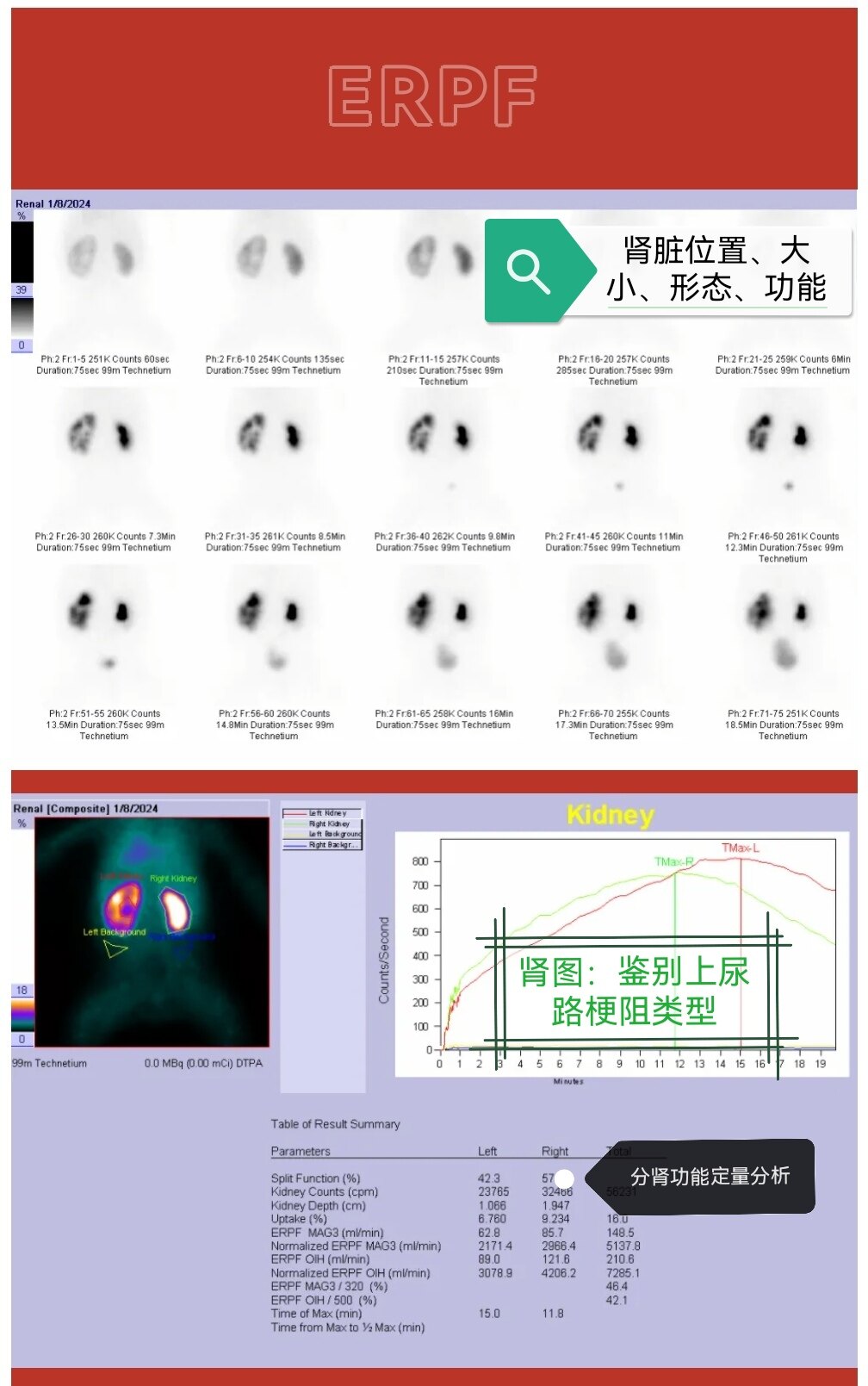 利尿肾动态显像