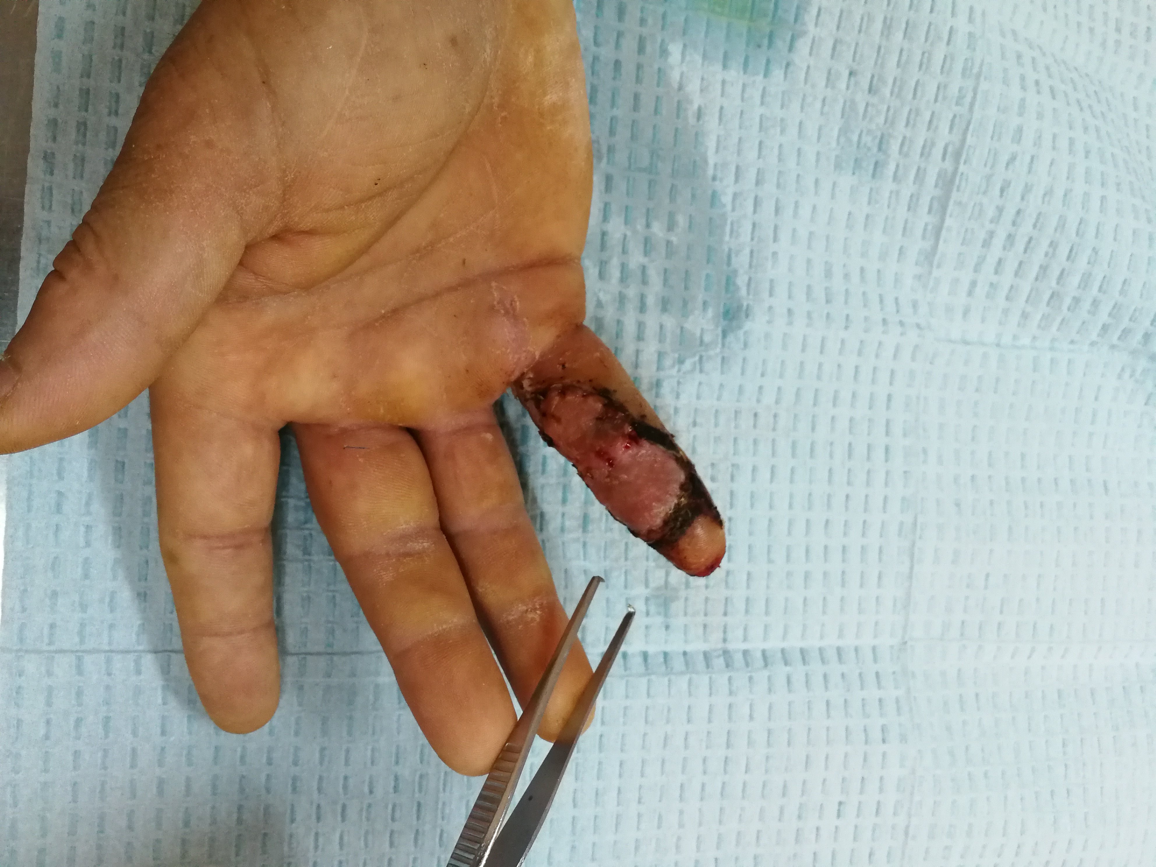 骨间背动脉穿支皮瓣修复手指皮肤软组织缺损的治疗. - 好大夫在线