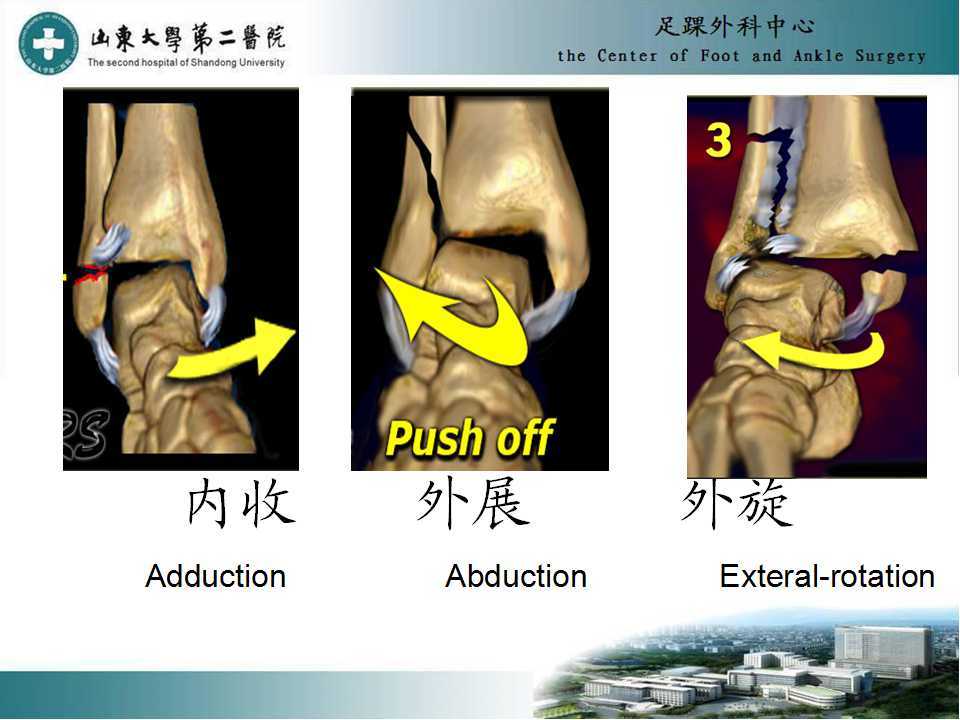 踝关节骨折分型图片