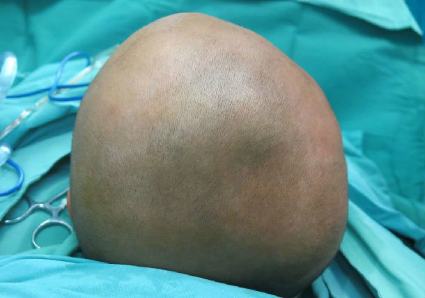 crouzon综合征头颅畸形矫正额眶前移颅内高压矫