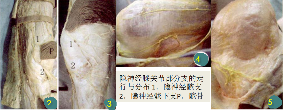 内侧及髌下区组(图2～5,隐神经分支组成,分布于髌下区和膝关节前内侧