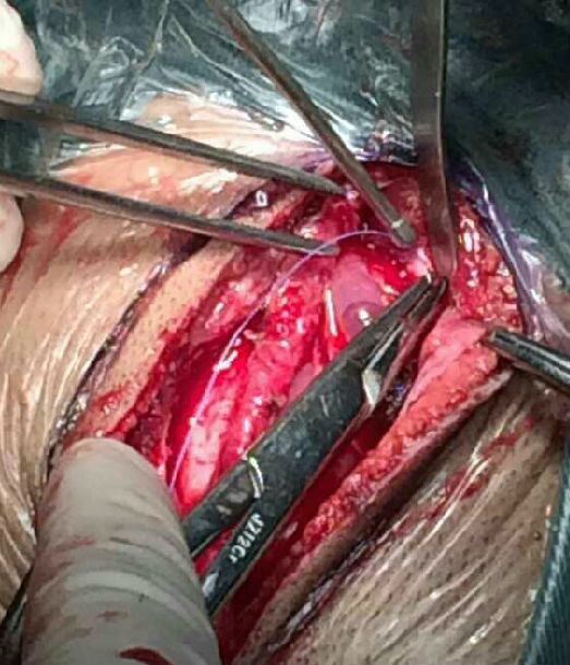 小儿烟雾病成功手术 - 好大夫在线