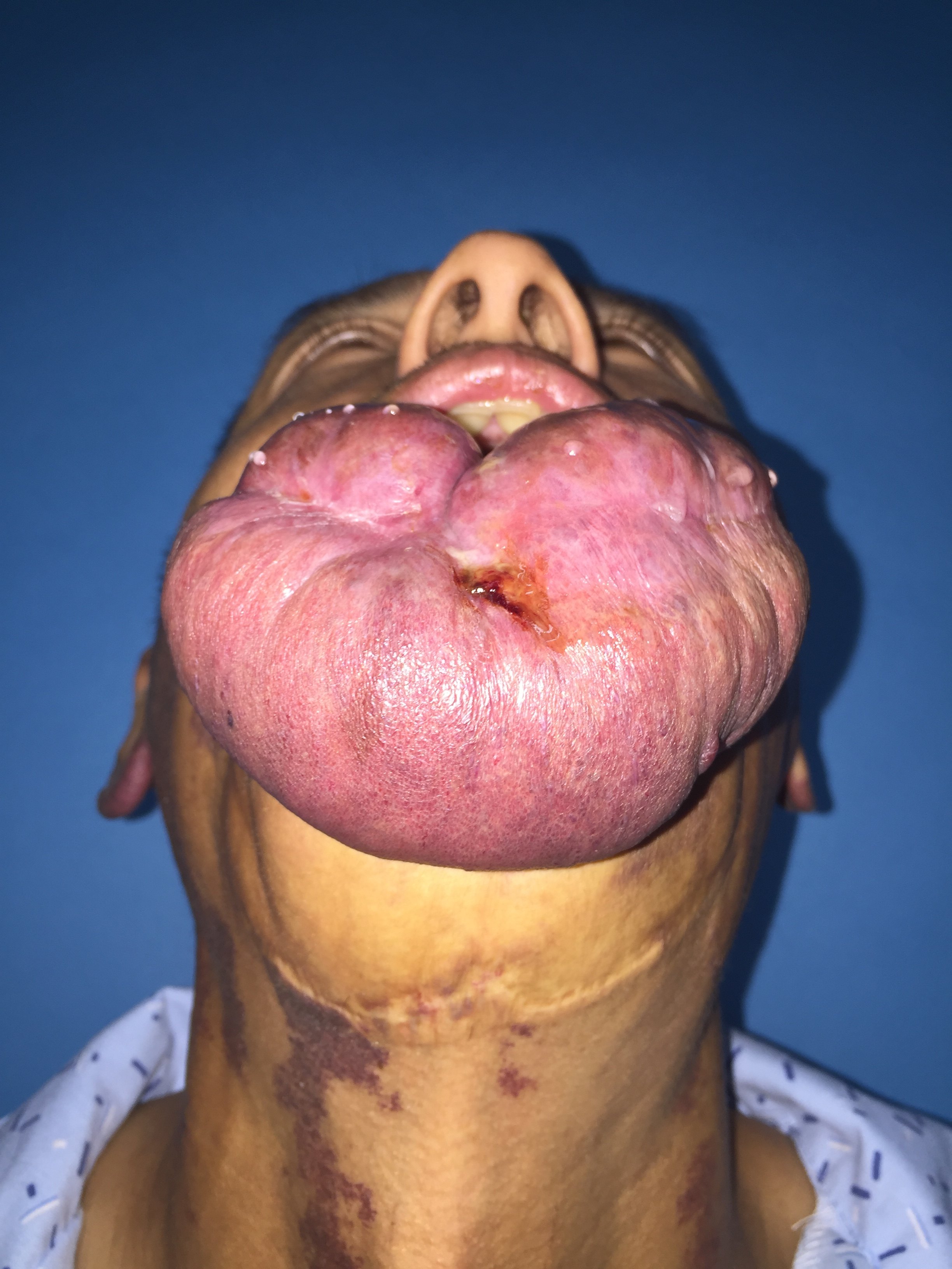 嘴唇血管畸形图片