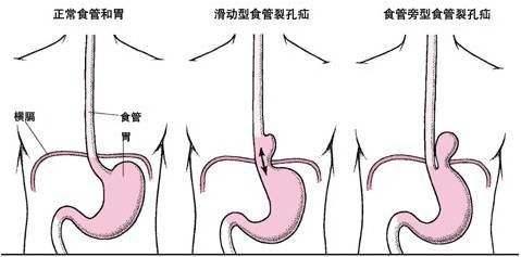 对于长期存在胃食管返流的情况,确切的治疗还是要通过外科手术,手术
