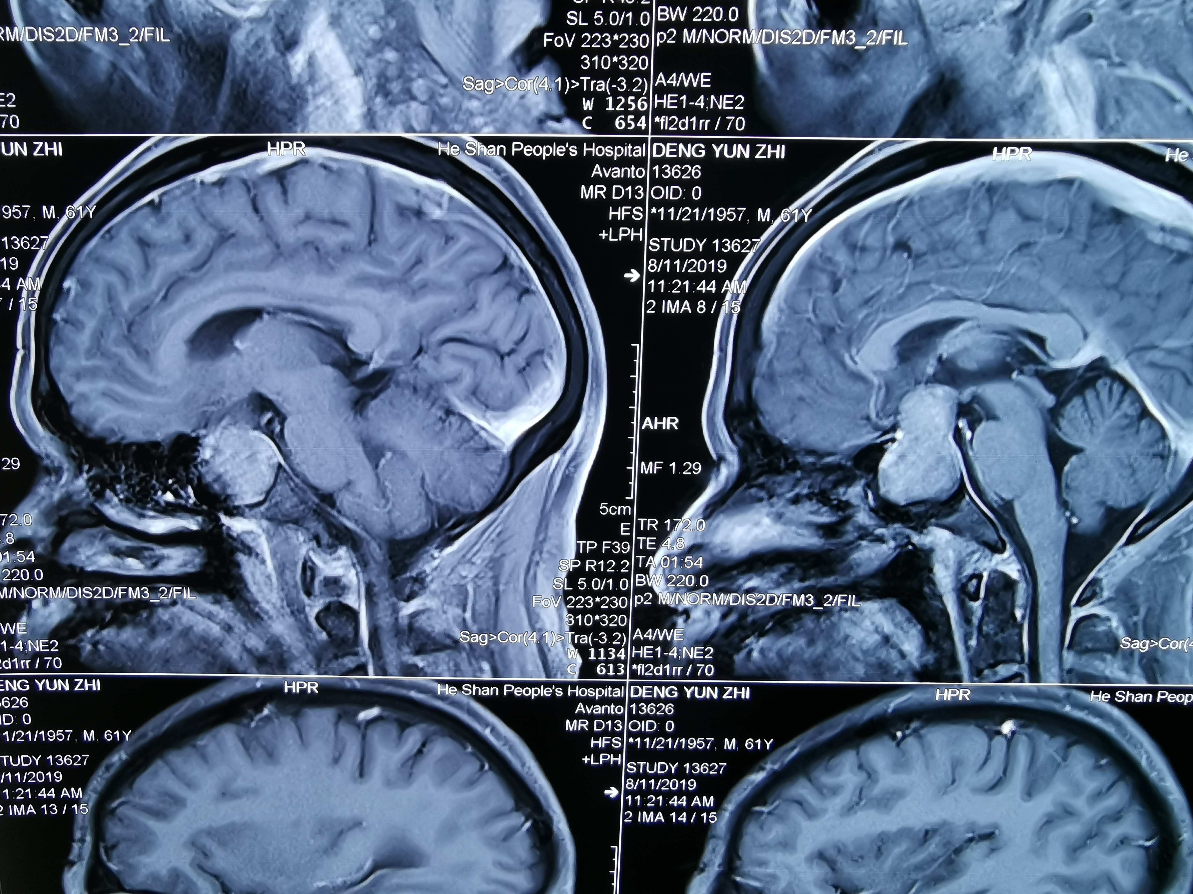 矢状位看肿瘤生长达三脑室底,视神经视交叉明显上台,鞍隔似乎完整