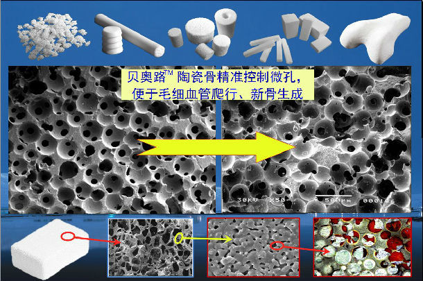 1808年初,成功製成了用於鑲牙的陶齒;1871年,羥基磷灰石被人工合成