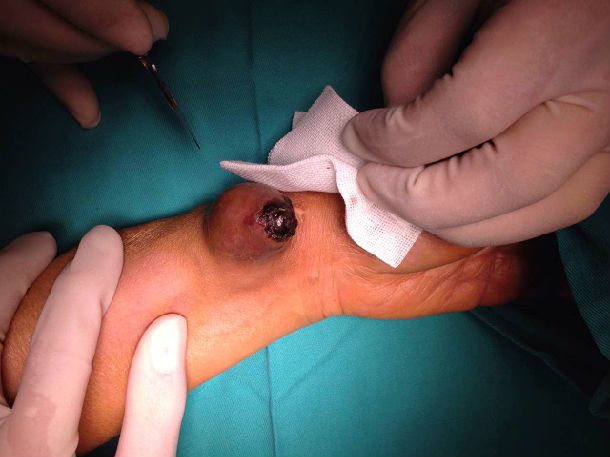 透析用自体瘘假性动脉瘤切除并瘘口修补手术 