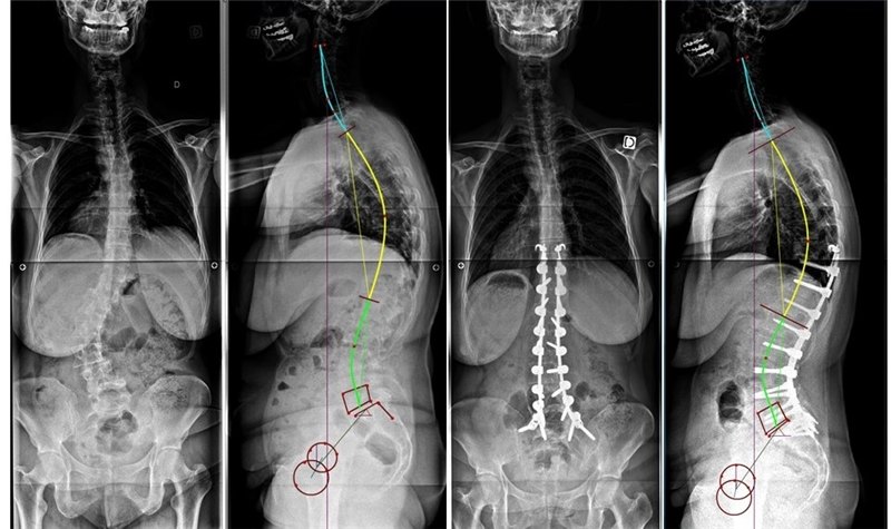 roussouly脊柱矢状面理论精要 - 好大夫在线