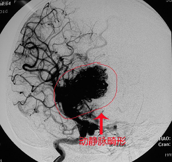 右侧额颞开颅额叶岛叶动静脉畸形切除