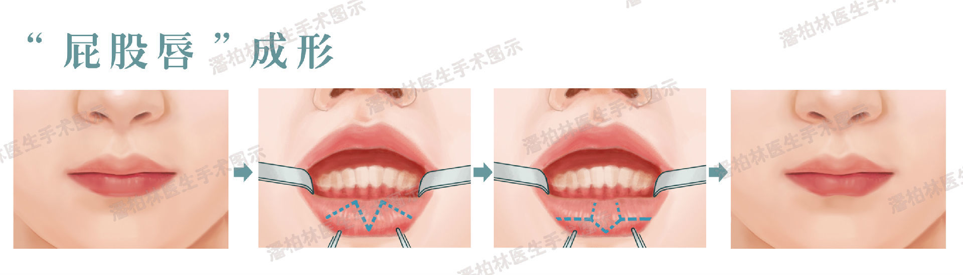 下唇综合整形(lower lip vermilion plasty:修薄"屁股唇"月牙唇"