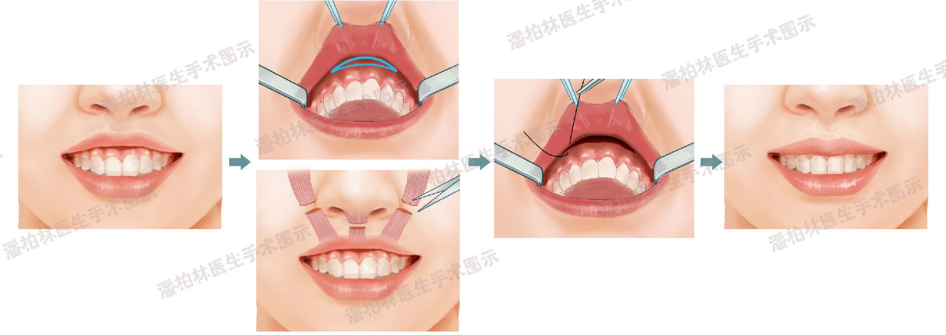 突):口内切口,松解离断双侧上唇方肌,降鼻中隔肌;如合并上唇人中过短