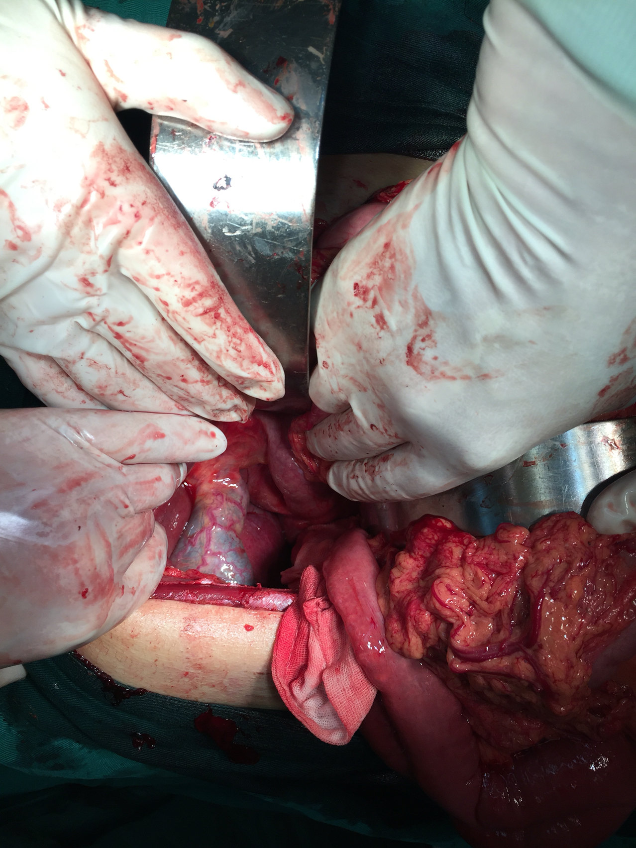 深夜救治车祸腹部损伤肠断裂