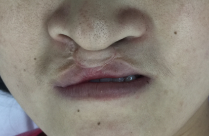 双侧唇裂的二期修复交叉唇瓣手术. - 好大夫在线