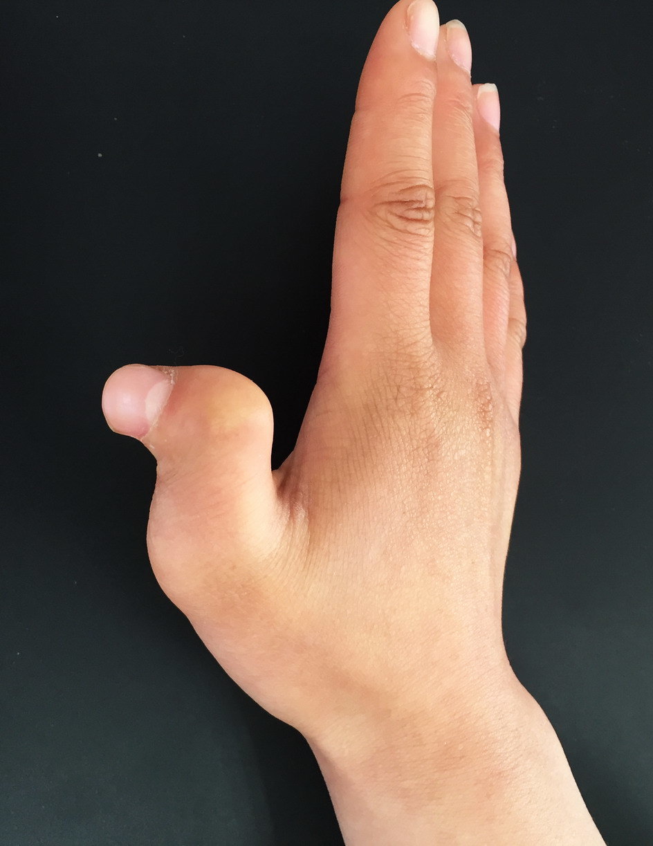 先天性拇指畸形矫正-方法千变万化,原则只有一条_好大夫在线