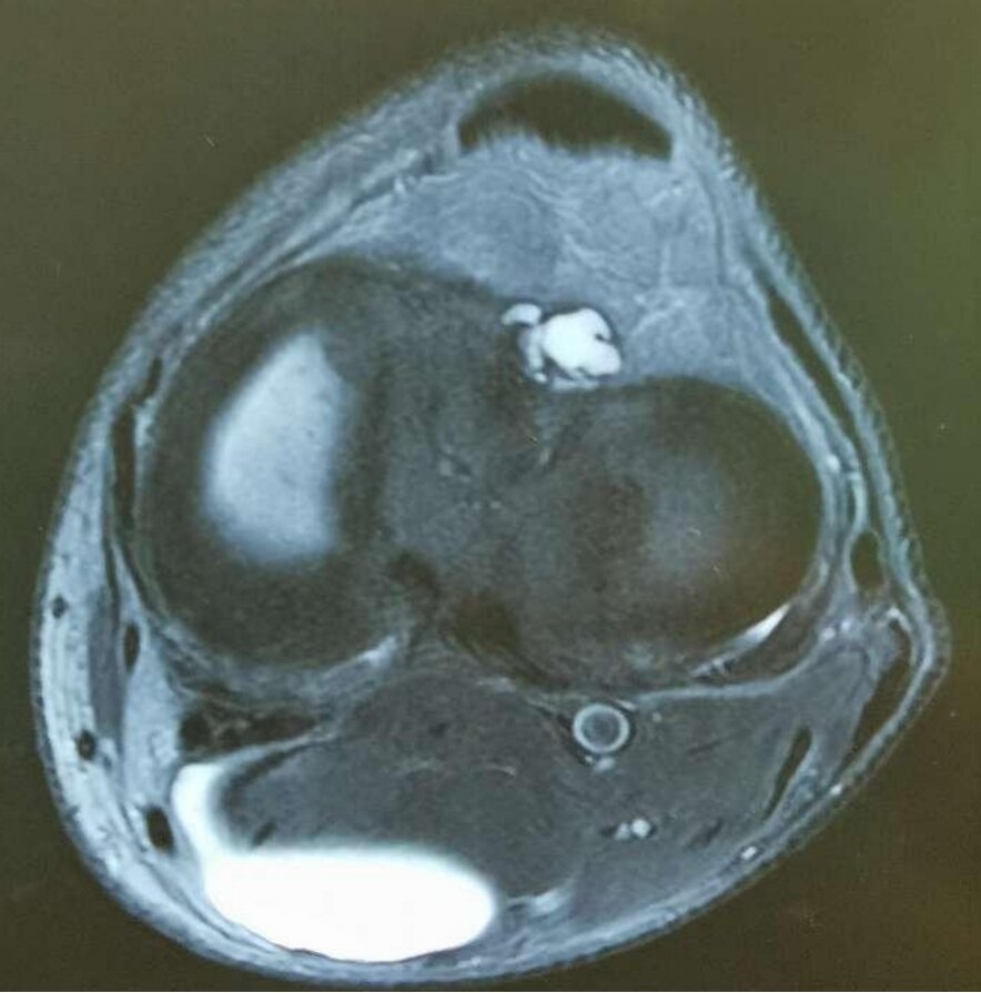 浅谈腿窝的包块