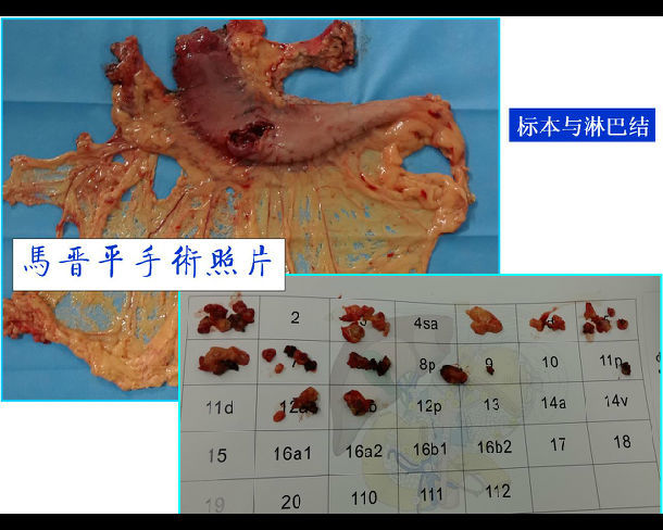 一例胃窦癌根治手术