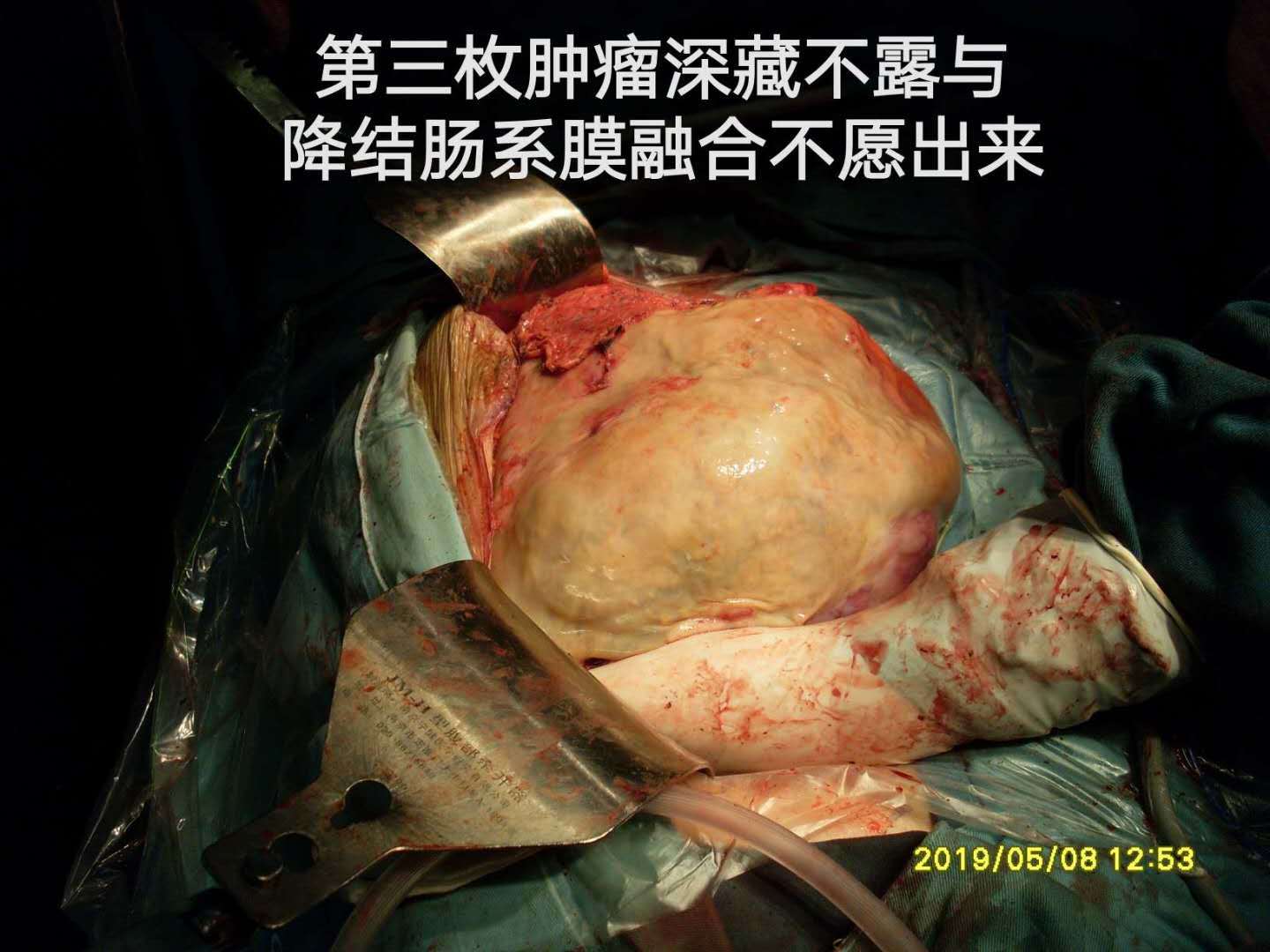 病例58復發生長迅速的腹腔肌纖維母細胞肉瘤伴腎功能不全