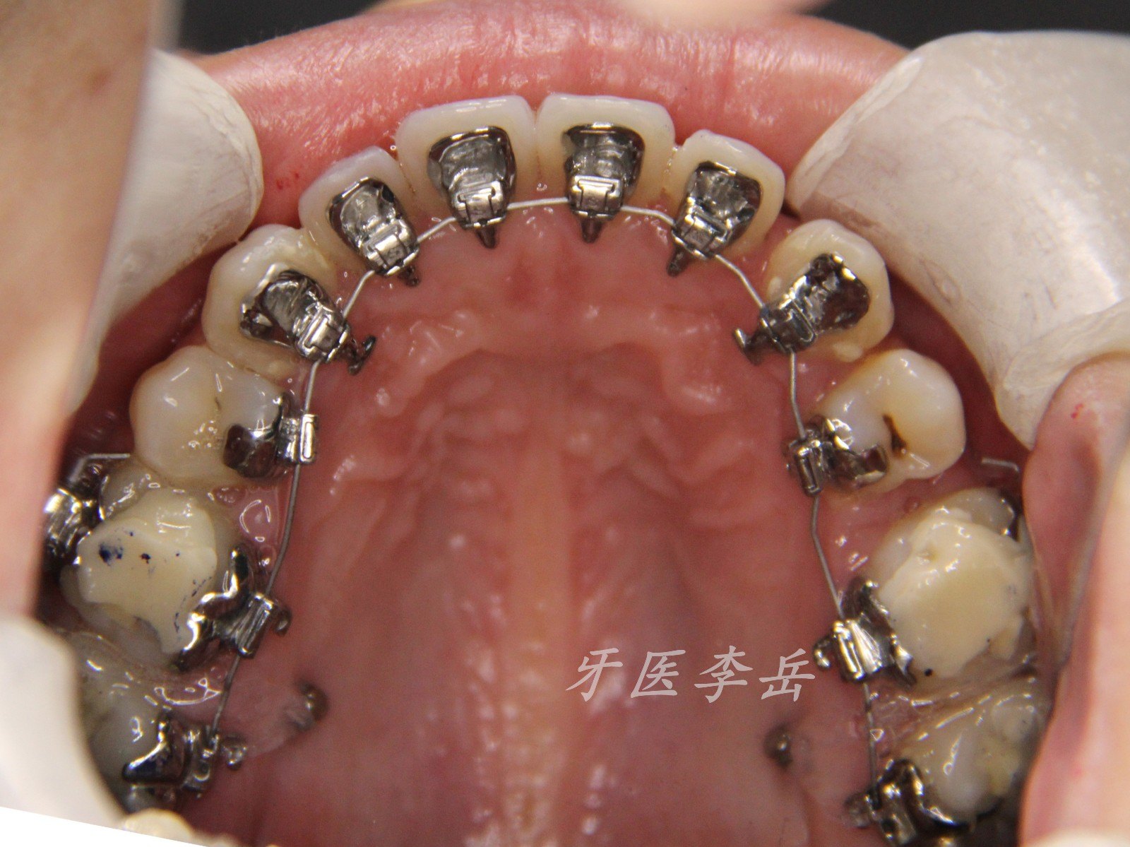 舌侧矫治------骨性开颌的舌侧治疗_牙颌畸形_治疗方法_治疗方式 - 好