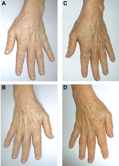 图6.缝合完即刻.图5.术中操作.图4.设计手背除皱的切口.图3.