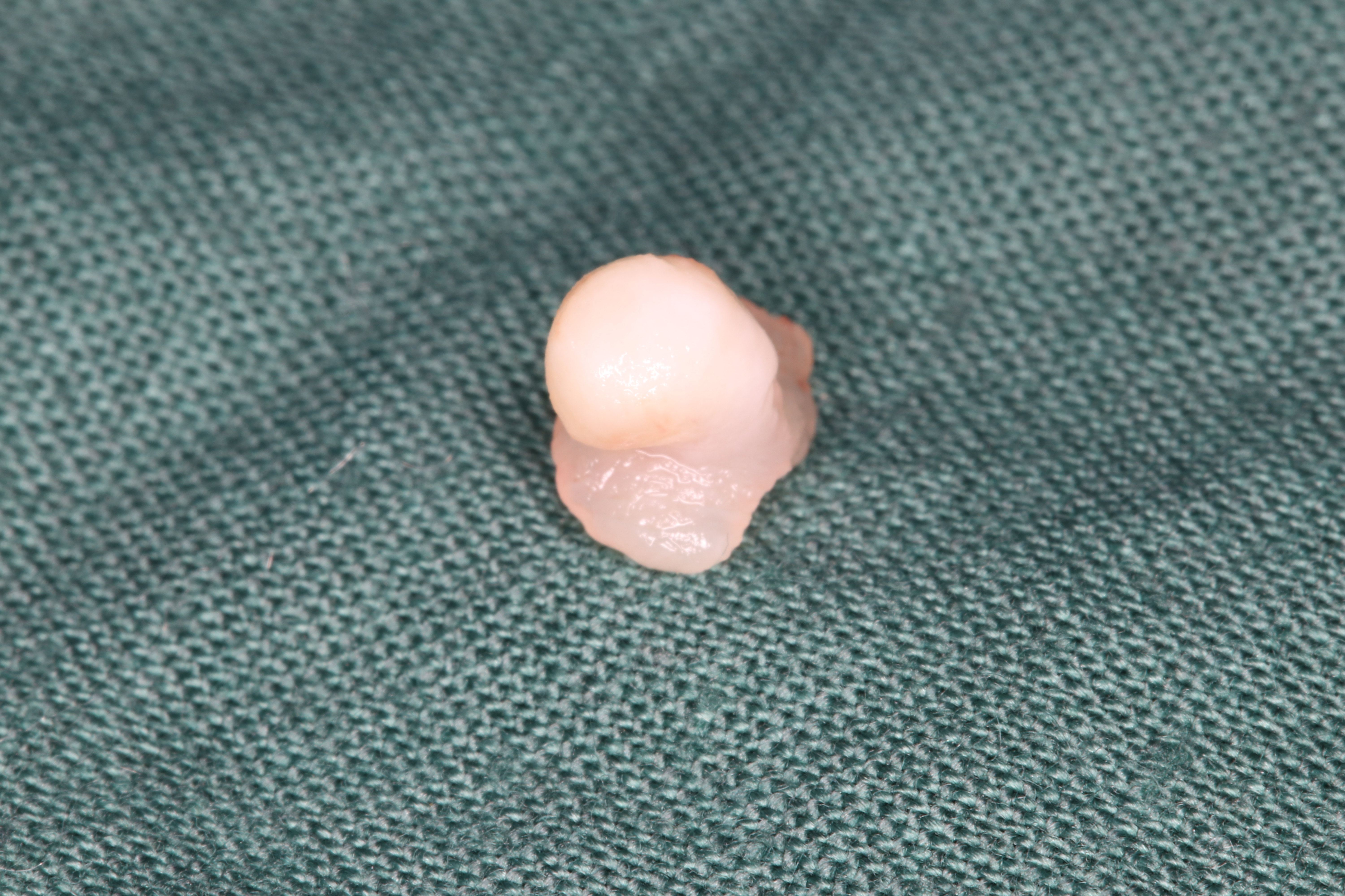 舌根部乳头瘤图片