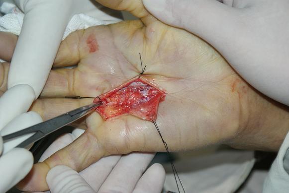 dupuytren病 - 好大夫在线