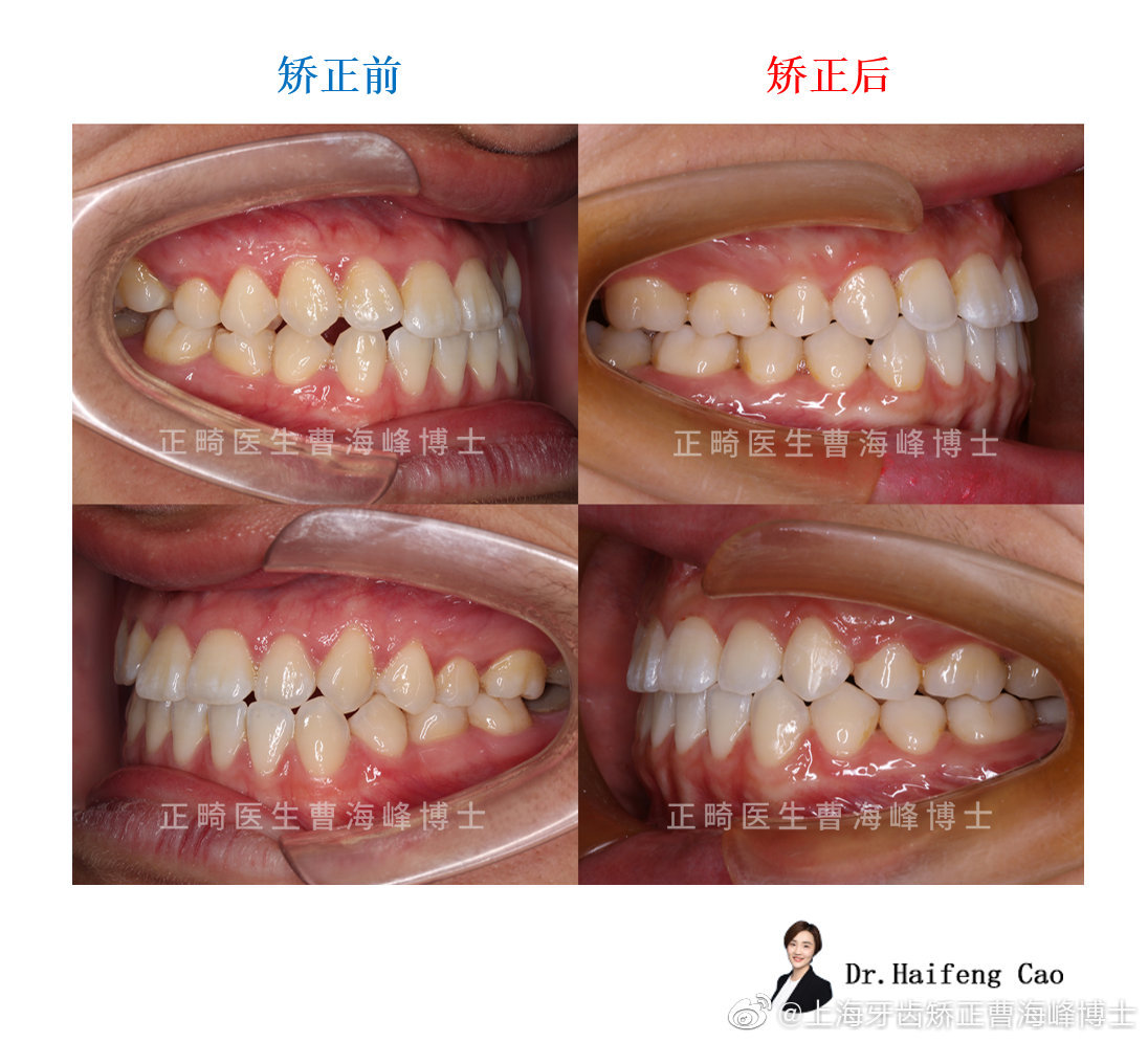 現在牙齒整齊,咬合正常,面下1/3立體飽滿增加,面型得到大幅度提升