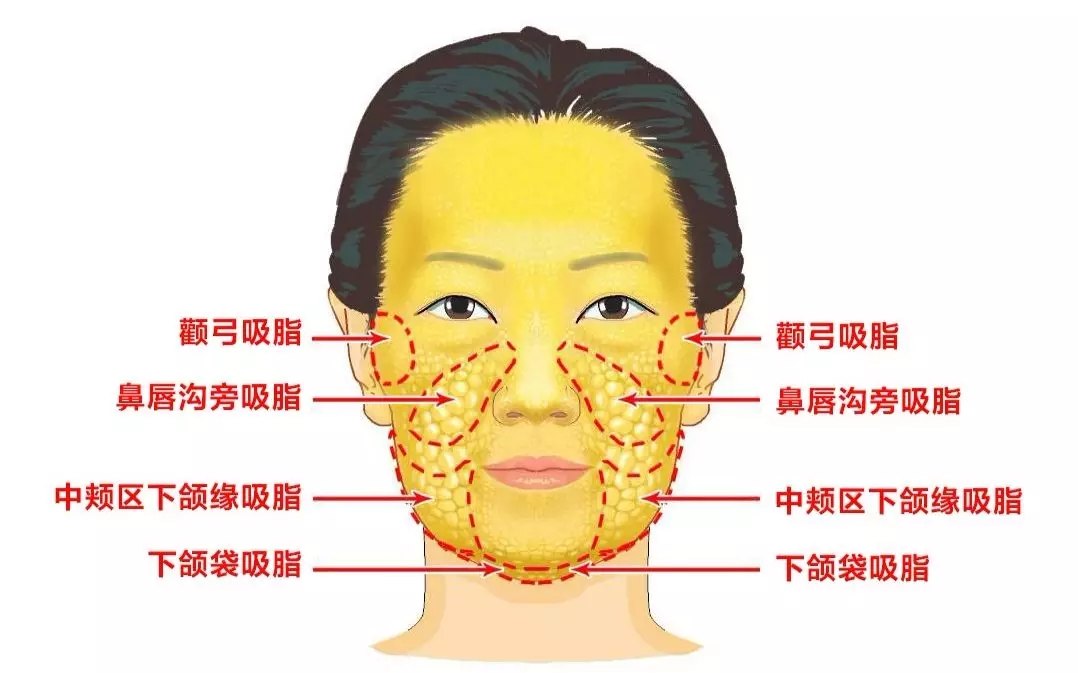 面部吸脂原理图片