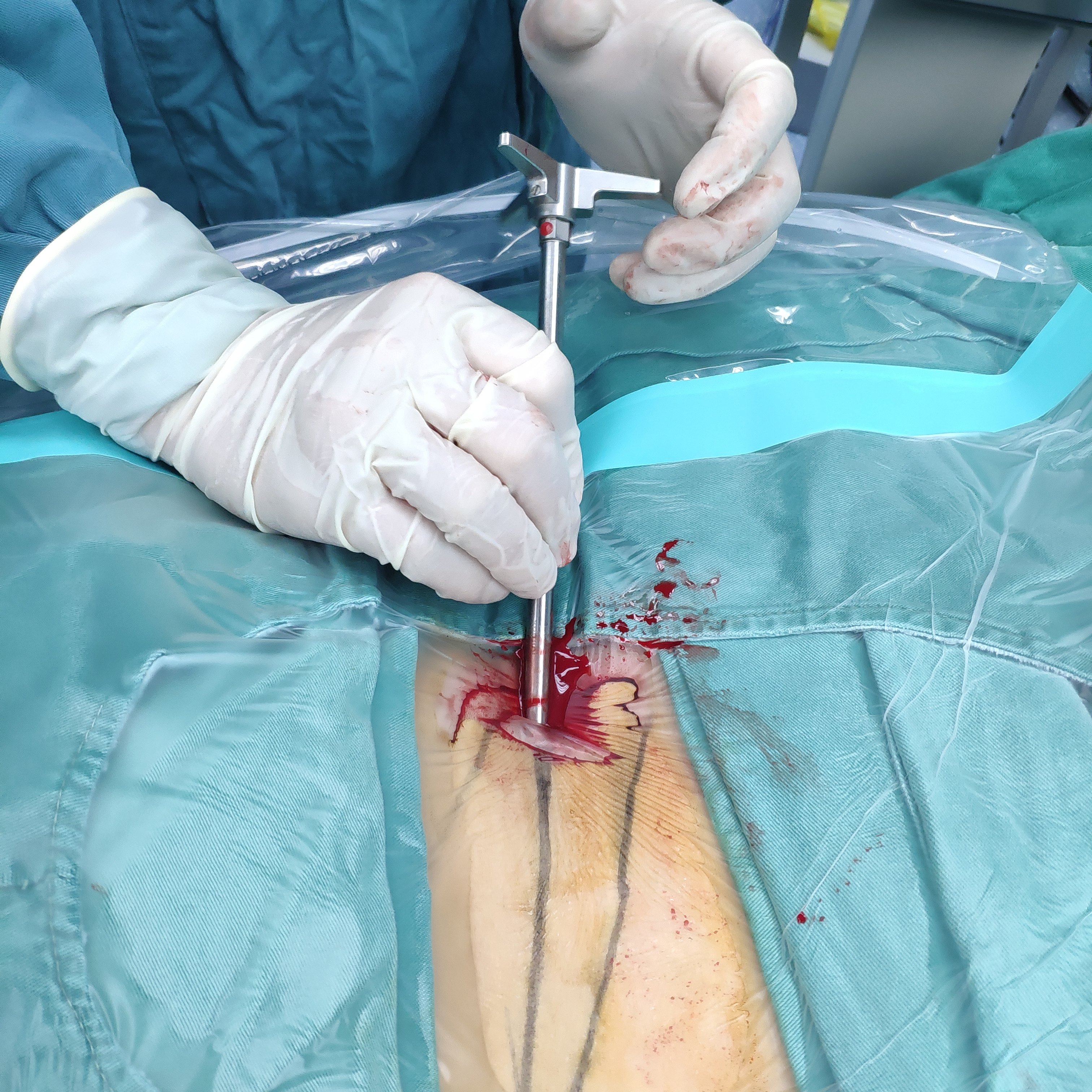 微创经皮椎间孔镜下髓核摘除术治疗腰椎间盘突出症