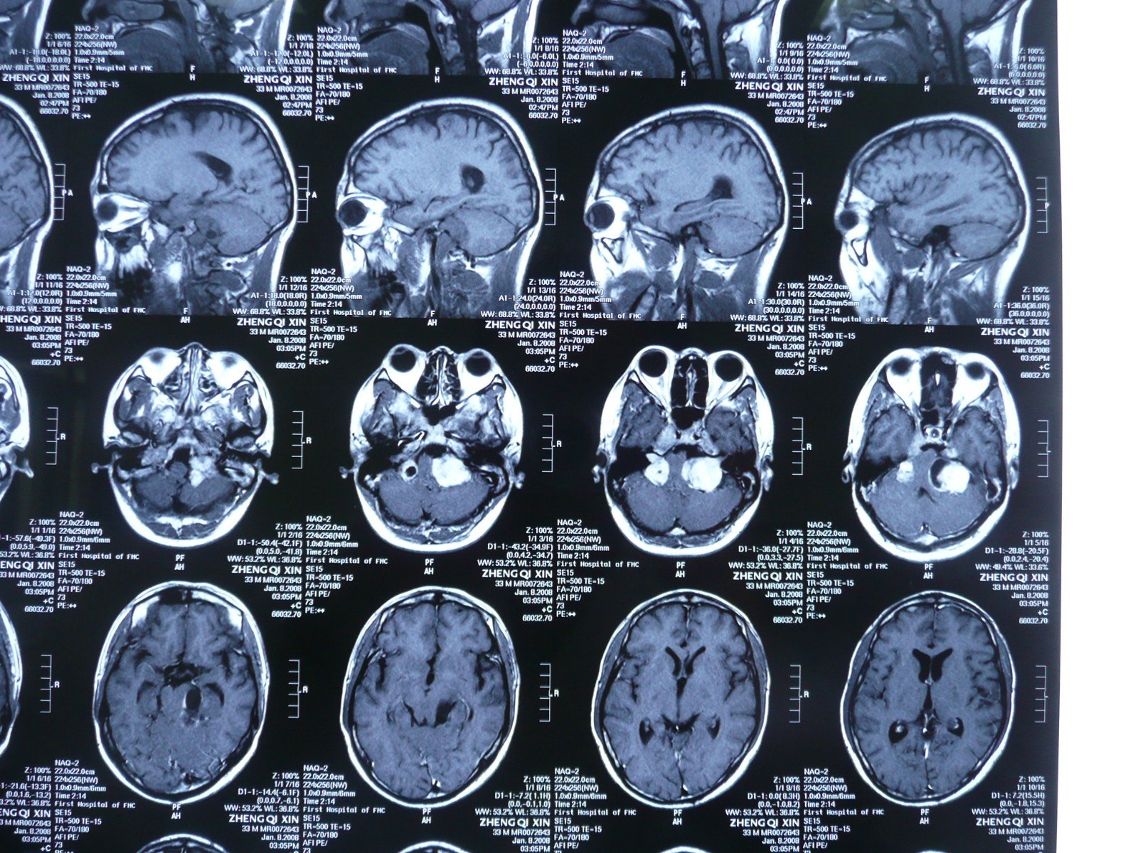 贺晓生教授多发神经纤维瘤病案例 - 好大夫在线