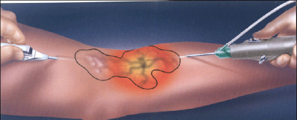 微小切口治疗静脉曲张——透光旋切术